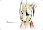 Osgood-schlatter Disease