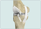 ACL Reconstruction