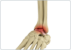 Arthritis of the Foot and Ankle