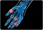 Arthritis of the Hand