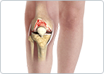 Arthritis of the Knee
