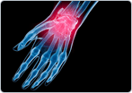 Arthritis of the Wrist