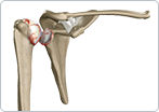 Arthritis of the Shoulder