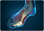 Bunion Surgery