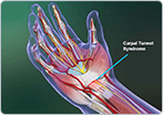 Carpal Tunnel Syndrome