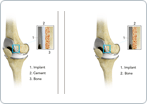 Cemented and Cementless Knee Replacement