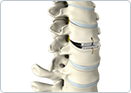 Cervical Disc Replacement