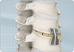 Cervical Discectomy