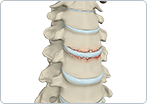 Cervical Fracture