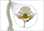 Cervical Laminoplasty