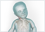 Congenital Torticollis