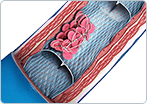 Deep Vein Thrombosis