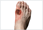 Diabetic Foot