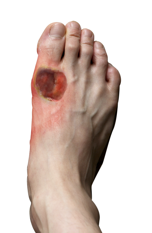 diabetic foot