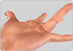 Dupuytren’s Contracture