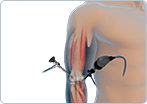 Elbow Arthroscopy