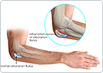 Elbow (olecranon) Bursitis