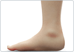 Flexible Flatfoot in Children