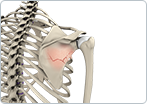 Fracture of the Shoulder blade (scapula)