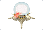 Herniated Disc