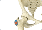 Hip Bursitis