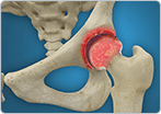 Inflammatory Arthritis of the Hip