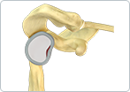 Shoulder Joint Tear