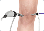 Knee Arthroscopy