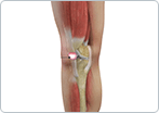 Kneecap Bursitis