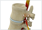 Lumbar Spinal Stenosis