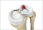 Meniscal Tear