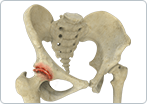 Osteoarthritis of the Hip