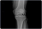 Osteonecrosis of the Knee