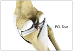 PCL Tear