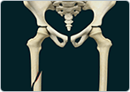Pediatric Thigh Bone Fracture