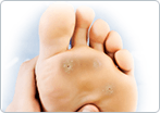 Plantar Warts