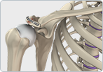 Plates and Screws fixation