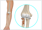 Radial Head Fracture