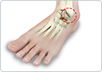 Rheumatoid Arthritis of the Foot and Ankle