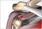 Rotator Cuff Repair