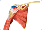 Rotator Cuff Tear