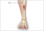 Shinbone Fractures