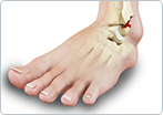 Stress fractures of the Foot and Ankle