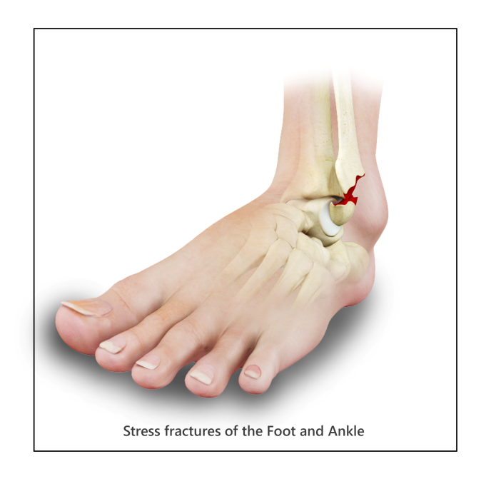 stress_fracture_foot