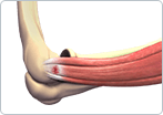 Tennis Elbow