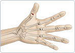 Thumb Fractures