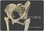 Total Hip Replacement