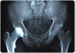 Transient Osteoporosis of the Hip