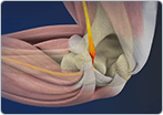 Ulnar Nerve Entrapment