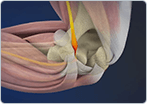 Ulnar Tunnel Syndrome